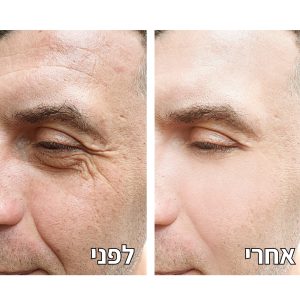 מתיחת פנים לגבר – תמונה לפני אחרי