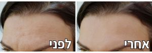 הזרקת בוטוקס במצח לפני ואחרי