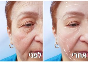 הזרקת חומרי מילוי לפני אחרי