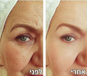 הזרקת חומרי מילוי לפני אחרי